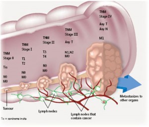 Cancer Basics-Part-2-Diagnosis-Prognosis-staging