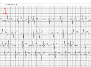 ECG