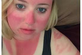 sunscreen-burn